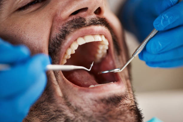 Best Knocked-Out Tooth (Avulsed Tooth) Treatment in Port Oconnor, TX