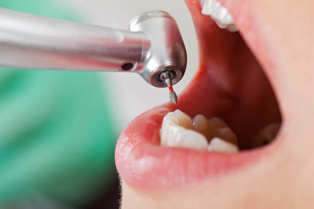 Best Broken or Chipped Tooth Repair in Port Oconnor, TX